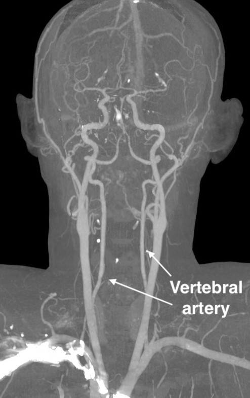 Vertebral artery anatomy