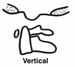 Atlanto occipital dislocation vertical