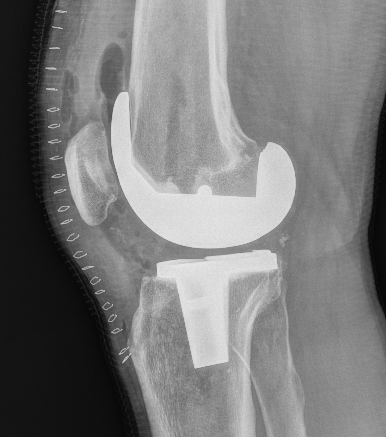 TKA Lateral